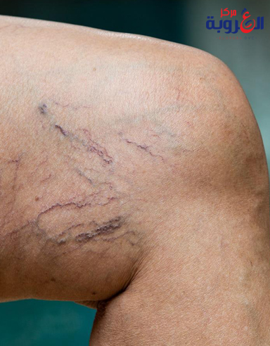 اسباب ظهور الدوالى