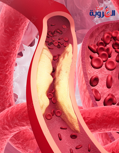 علاج انسداد الشرايين