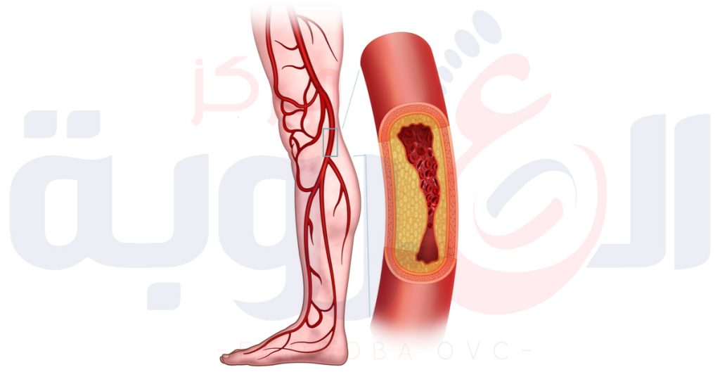 علاج انسداد شرايين الساق
