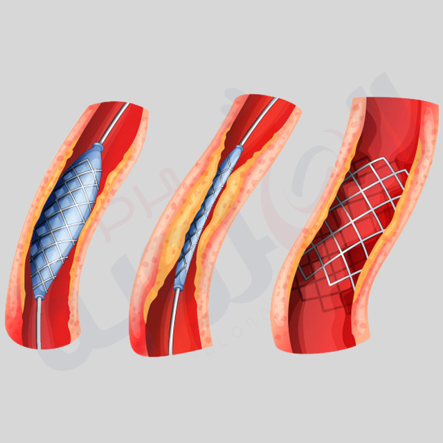 انسداد الشرايين فى القدم