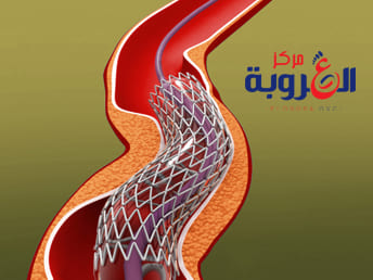 انسداد الشرايين