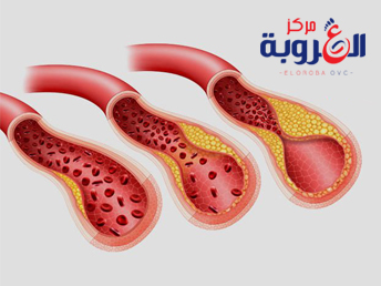انسداد