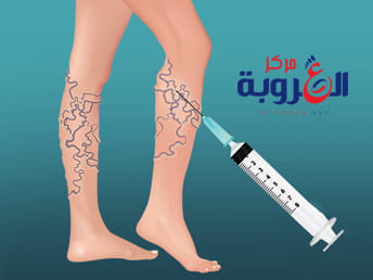 حقن الدوالى