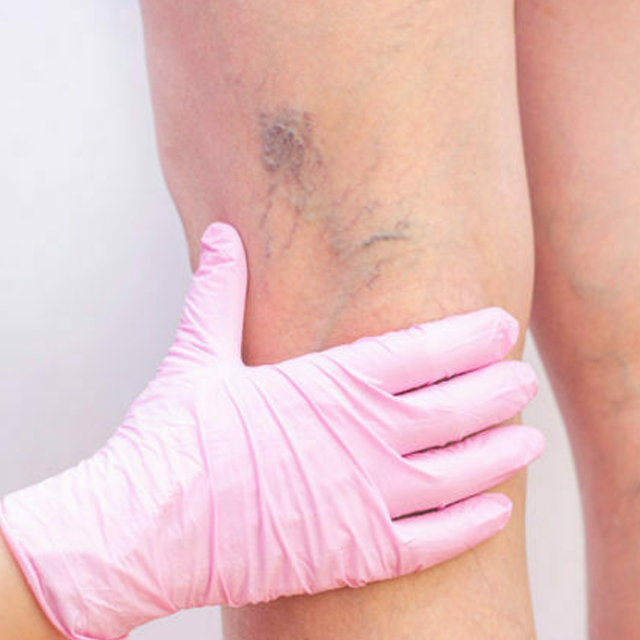 علاج دوالى الساقيين