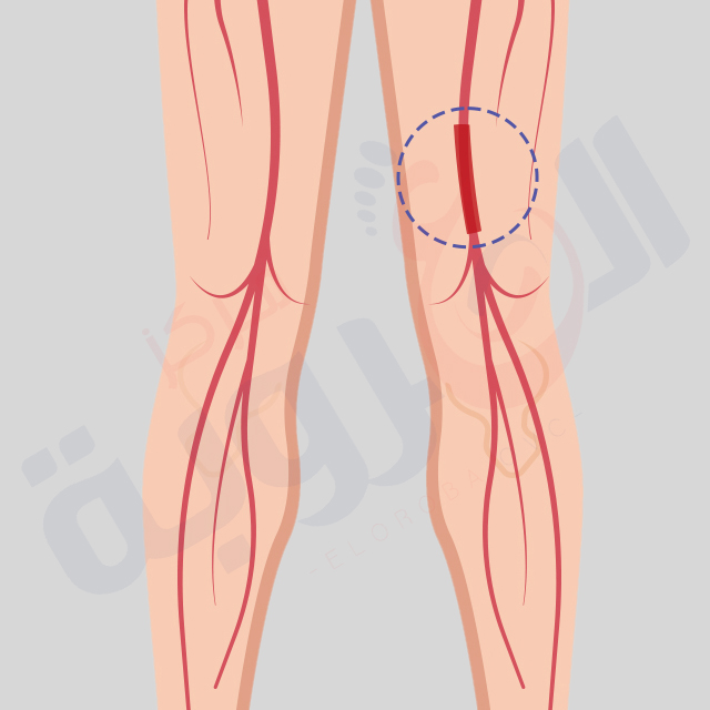 امراض الشرايين الطرفية